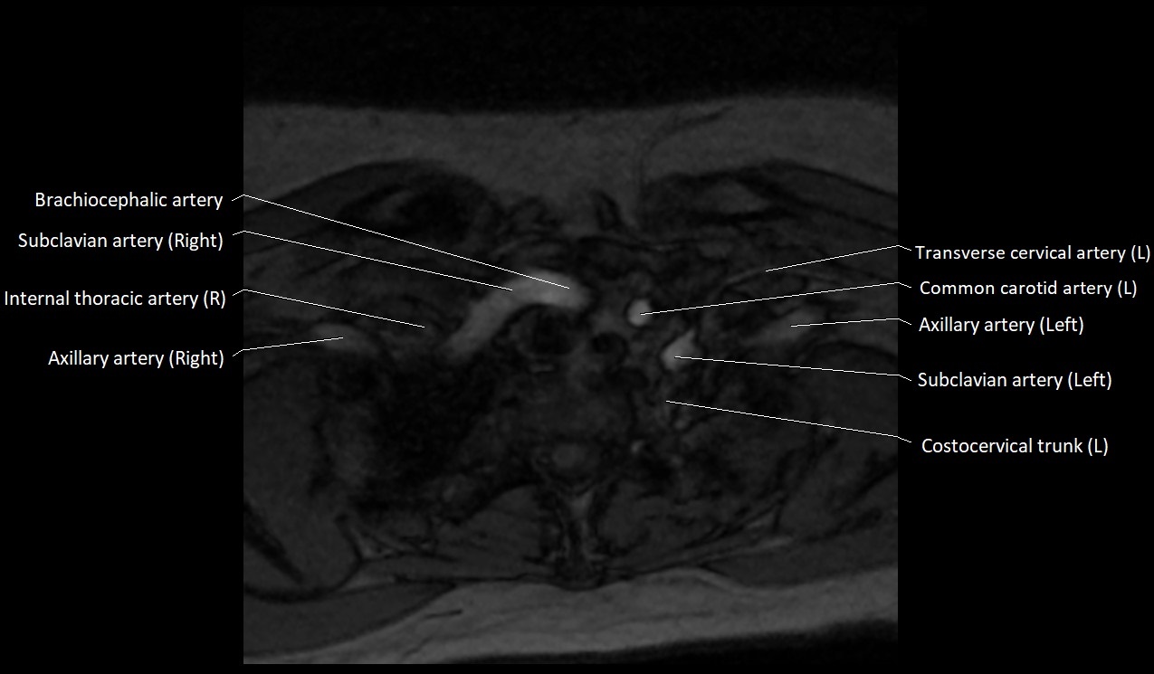 Carotid artery anatomy axial 3T image 71.jpg